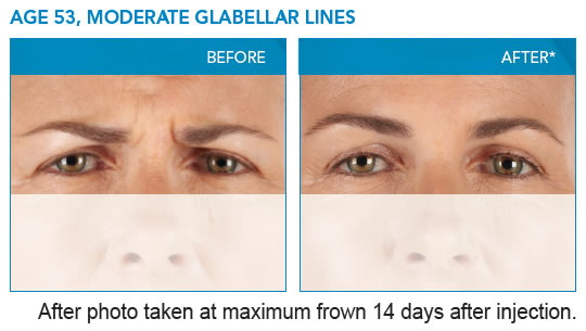 moderate-glabellar-lines