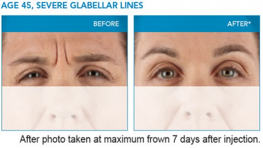 severe-glabellar-lines-2