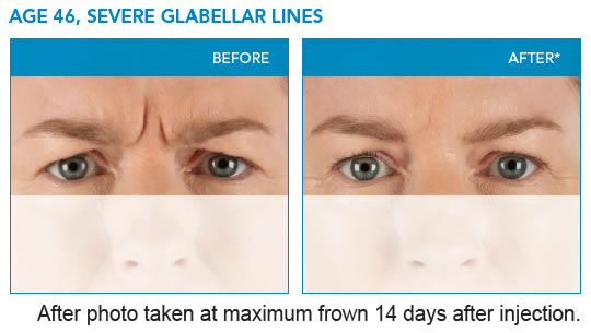severe-glabellar-lines3